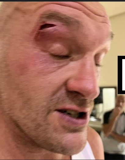 Tyson Fury eye cut